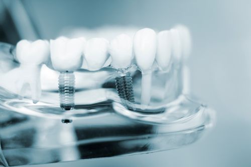 Zahnarztpraxis-Dr.-Martin-Weiss-Zahnarzt-Dillingen-Implantologie-Zahnmodell